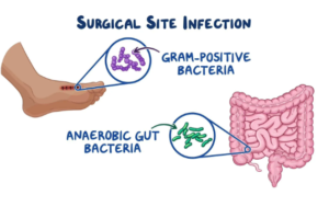 Surgical Site Infections